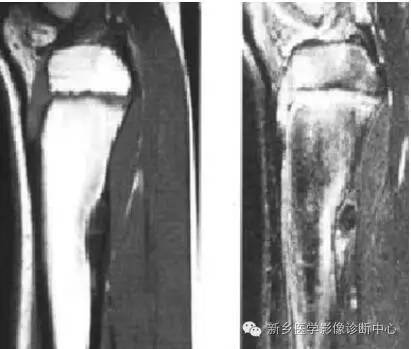 长骨膨胀性病变,长骨偏心性膨胀性病变