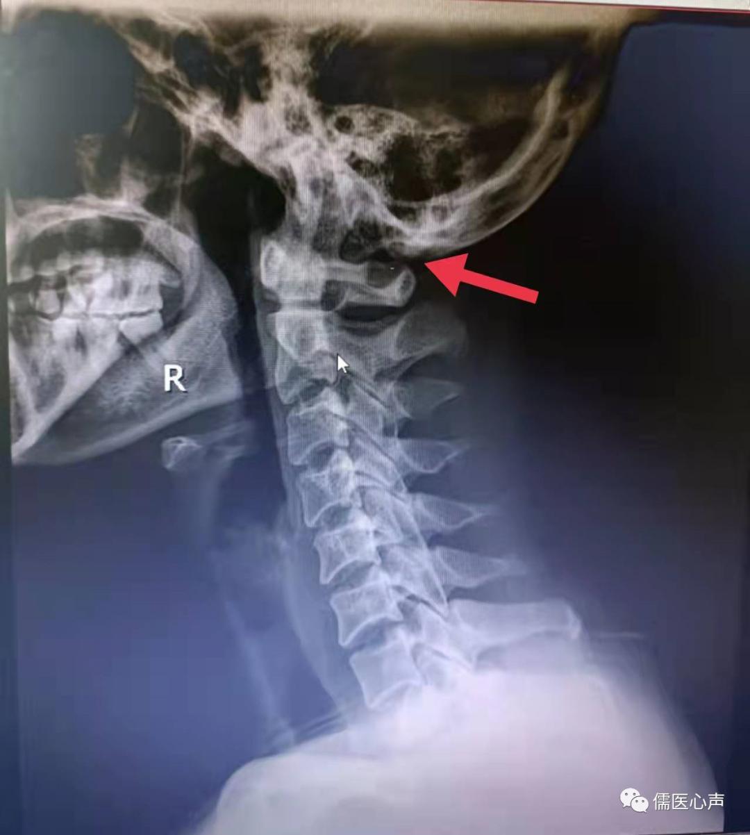 听力脑鸣伴随听力下降,脑鸣听力下降是什么原因