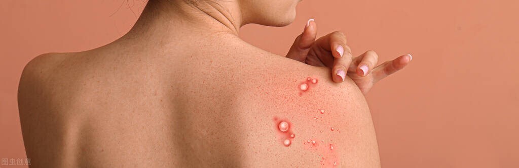 糖友这些区域长痘,不要用手去抠