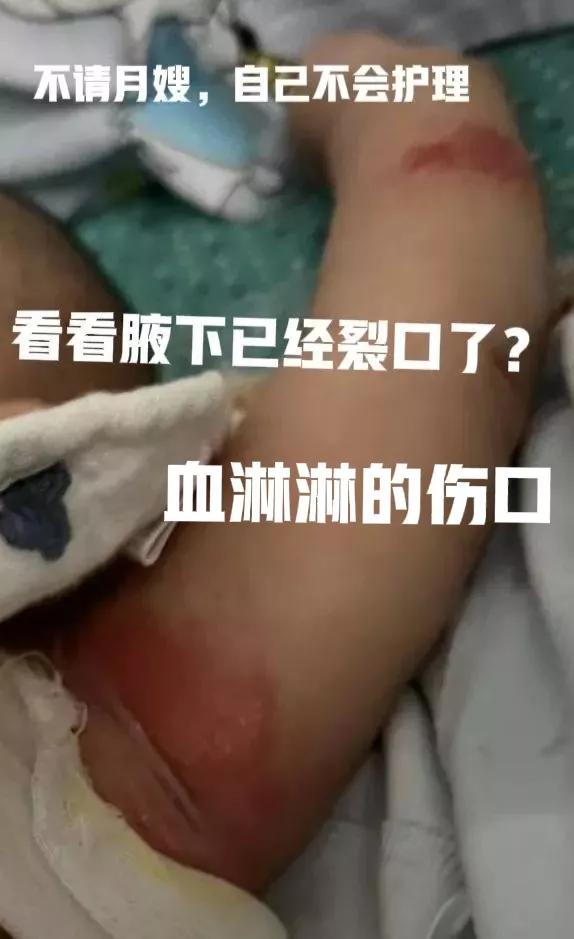 #宝宝腋下破皮了如何护理#