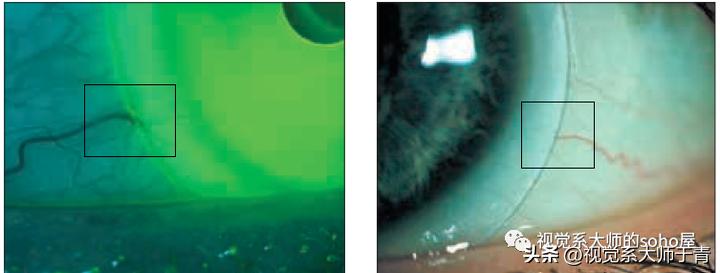 巩膜镜的验配技巧及案例分享,试戴巩膜镜成功率高不高