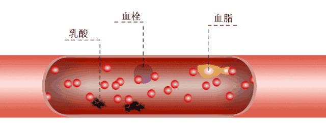 血为养命之源,血瘀体质易得心梗吗