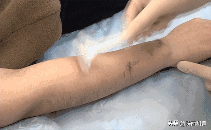 腋毛脱毛好还是刮掉好,腋毛永久去除会不会影响腋下排汗