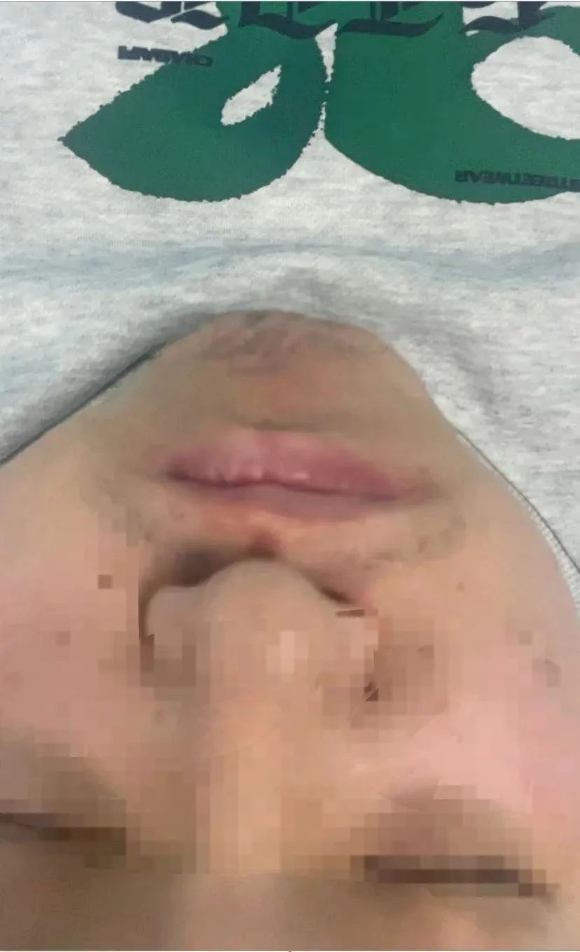 面瘫治疗难不难,面瘫流眼泪怎么治疗