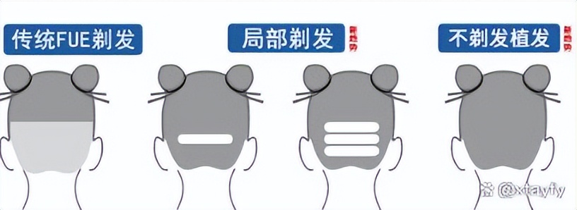 植发前先来算算植发该花多少钱,植发一般花多少钱就够了