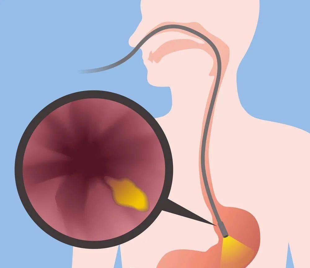 一般几年做一次胃镜为好,胃镜有必要每年都要做吗