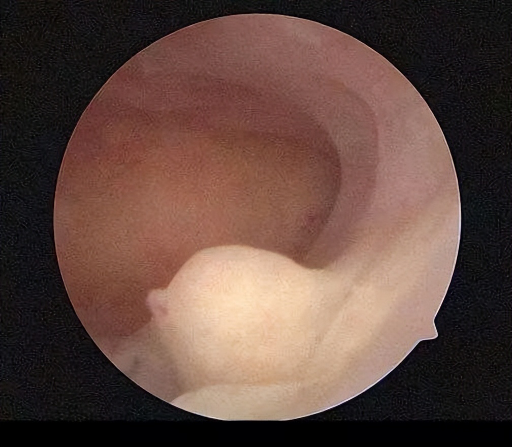 内膜息肉的克星,中医能治内膜增生和息肉吗