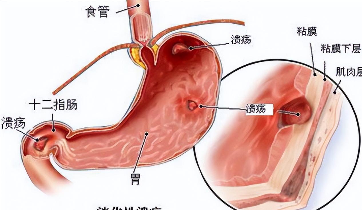 幽门螺旋杆菌脂肪肝,治疗幽门螺杆菌瘦了20斤