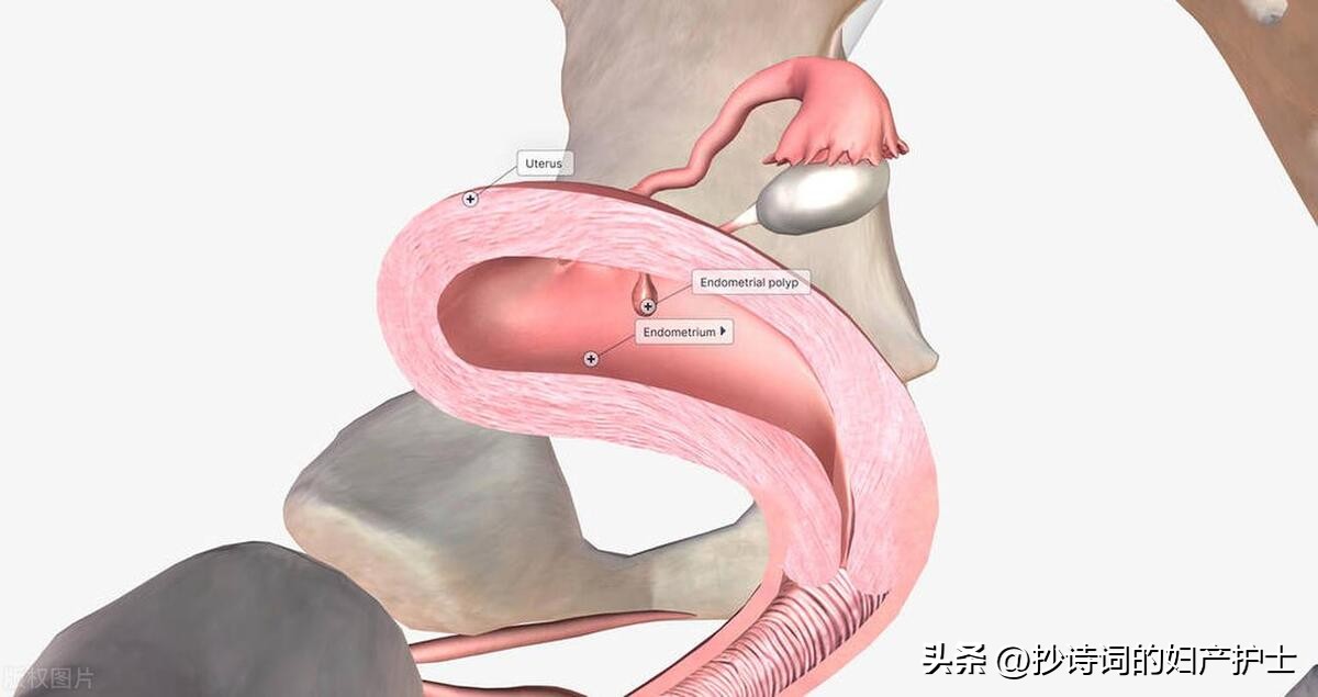 子宫内膜息肉，这个滋生出来的“小肉”，它会恶变吗