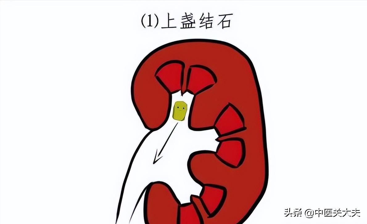 鍠濇按璺崇怀鑳芥帓0.2鍘樼背鑲剧粨鐭冲悧,鑲剧粨鐭宠烦缁宠璺冲涔呮墠鑳芥帓鍑烘潵