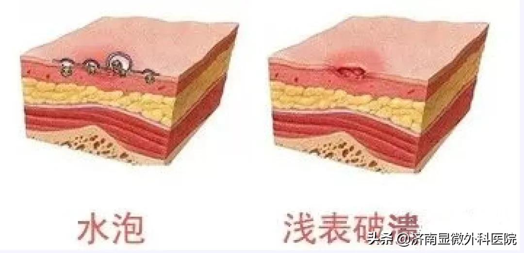 褥疮的分期是什么样,褥疮分期一般分为几期