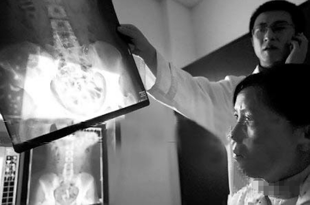 云南女子体内26根绣花针凶手是谁,云南女子缝衣针