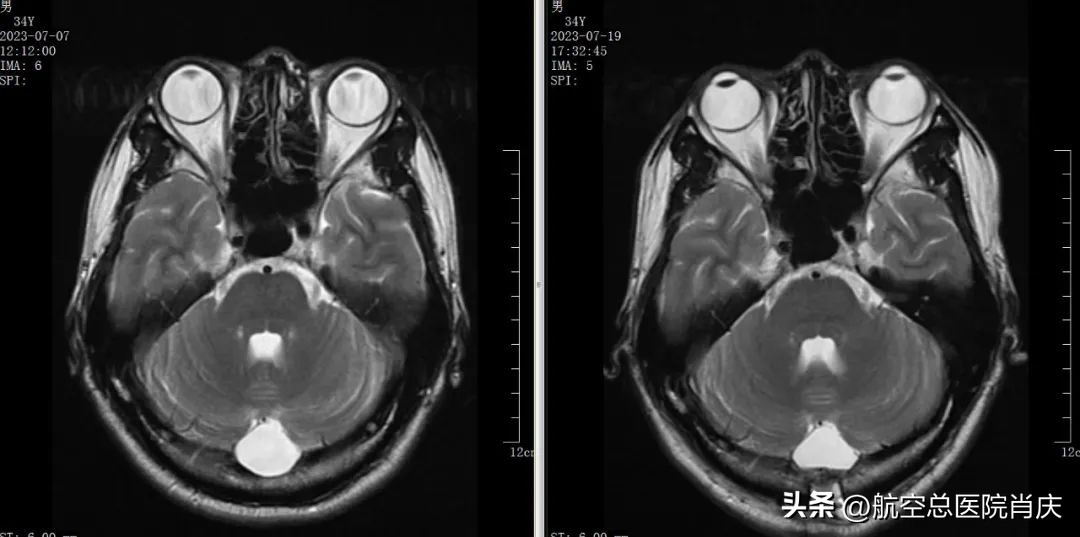 神外专家一个微创手术解决蛛网膜囊肿患者多年困扰重拾生活信心！