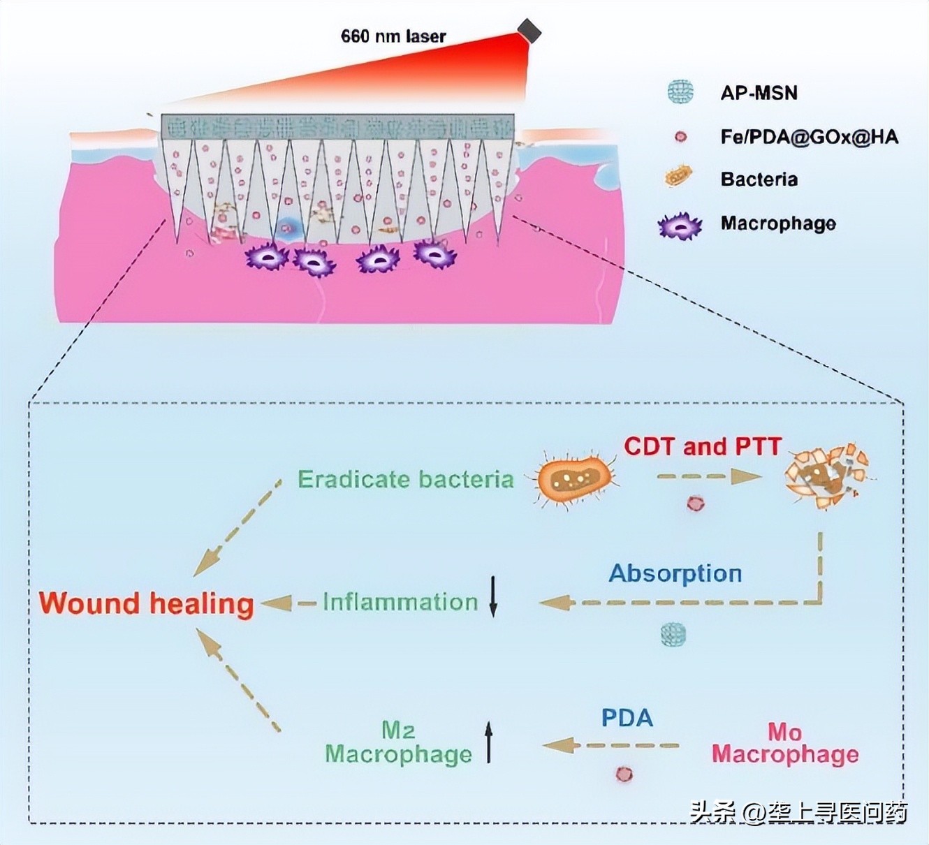 有效促进难愈性创面愈合武汉大学人民医院分子医学研究院研发具备抗菌和免疫调节功能的微针药物系统