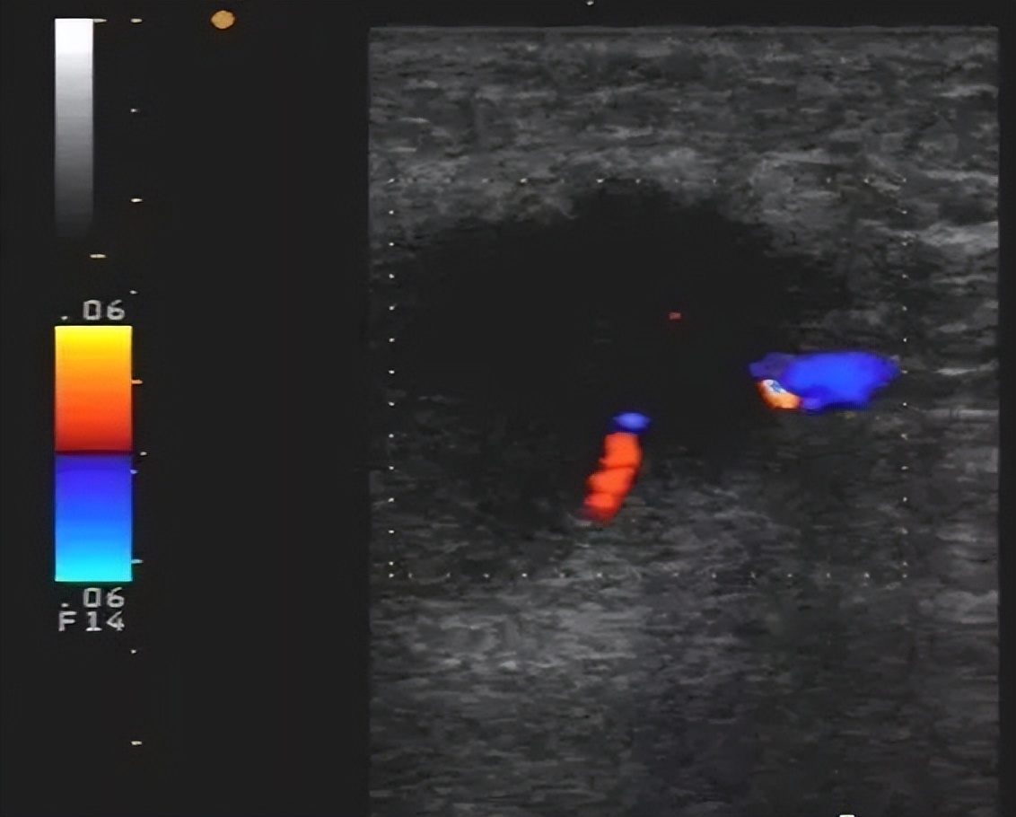 腋窝包块超声鉴别诊断,腋窝淋巴结检查法
