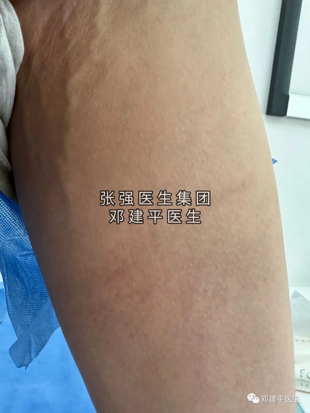 下肢静脉曲张非手术治疗护理,下肢静脉曲张2级吃药可以消除吗