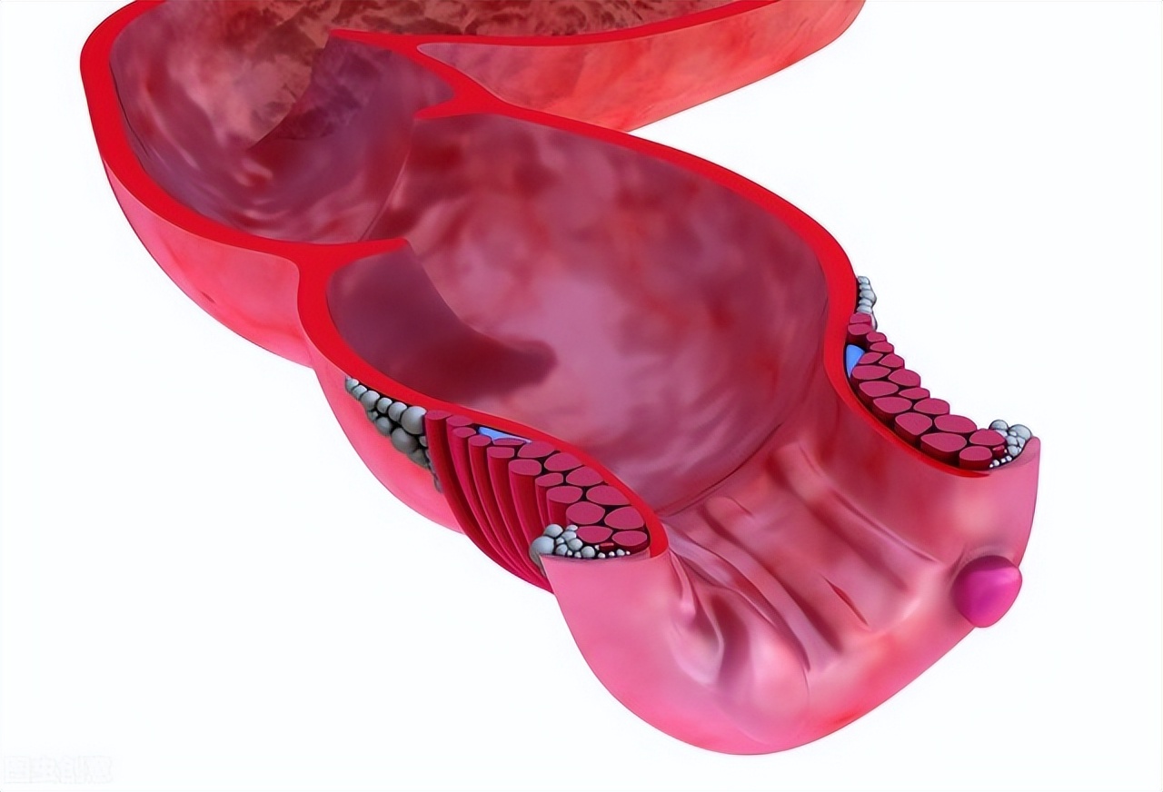 混合痔疮手术40天大便疼出血痒,做了痔疮手术后里边有脓怎么办