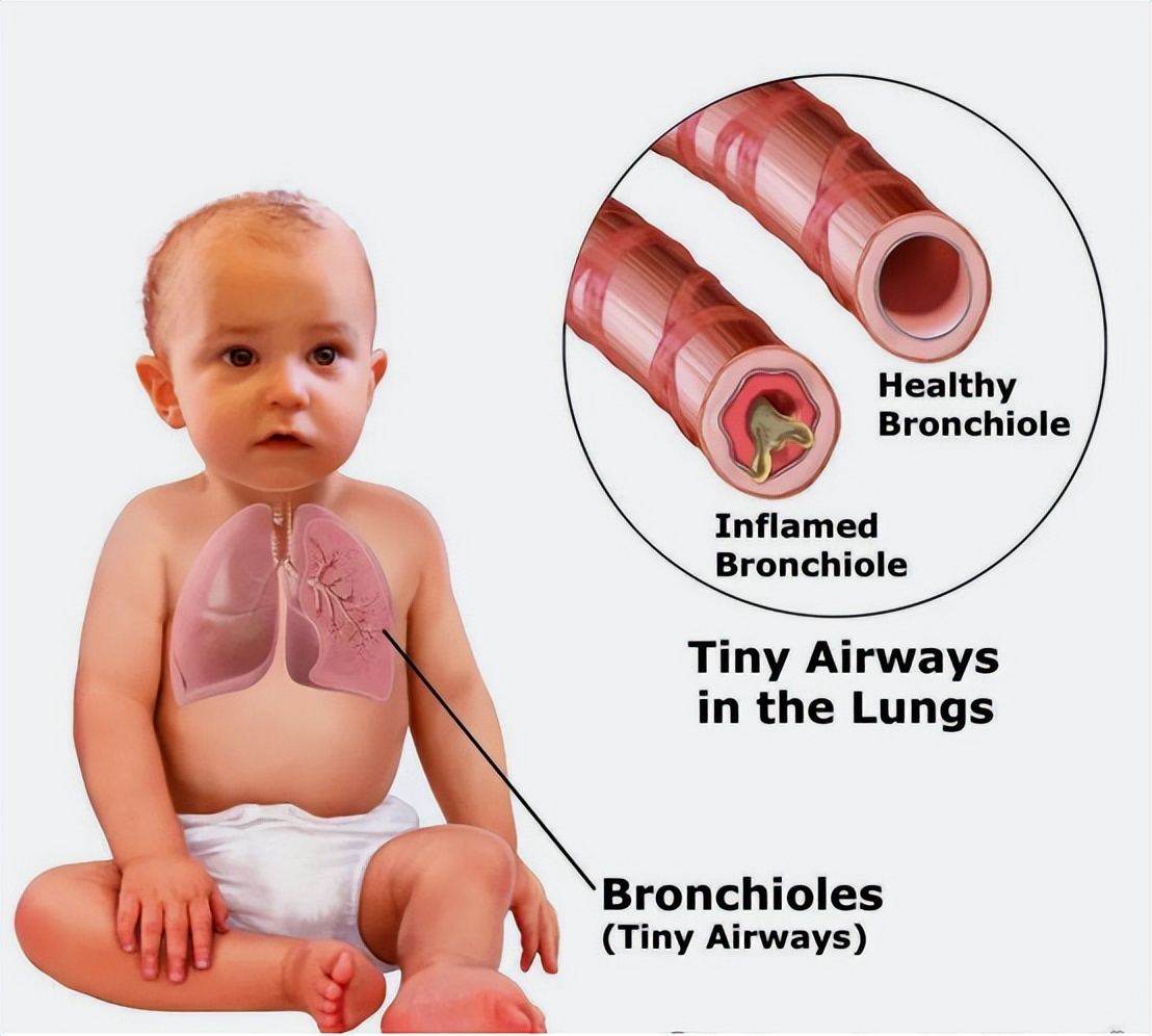 新生儿呼吸衰竭病例分析题,新生儿呼吸衰竭是什么原因引起的