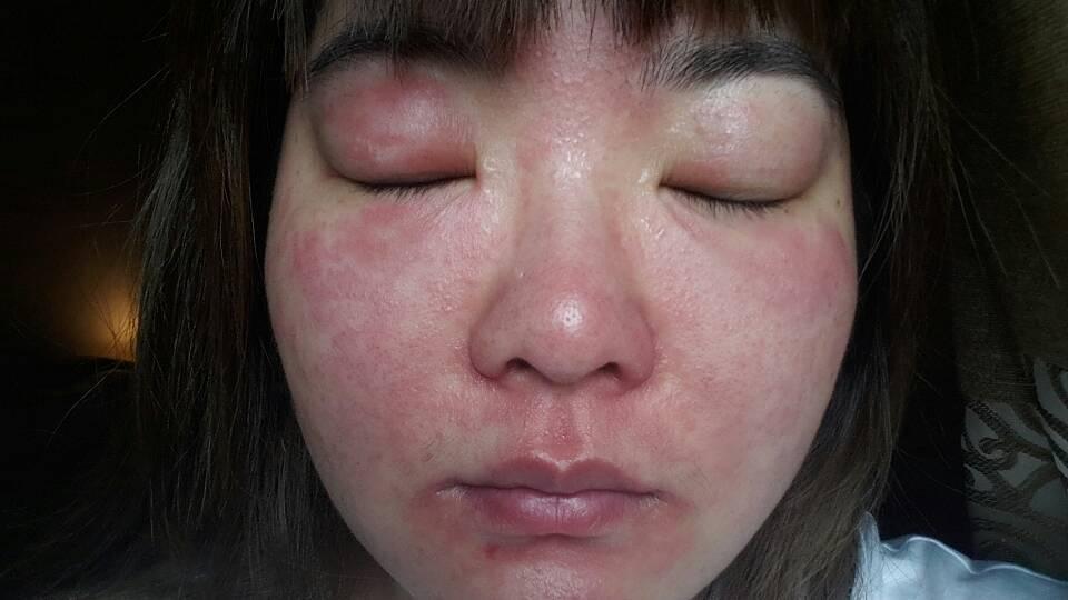 内行人推荐的护肤品,烂脸反复爆痘护肤品真实测评