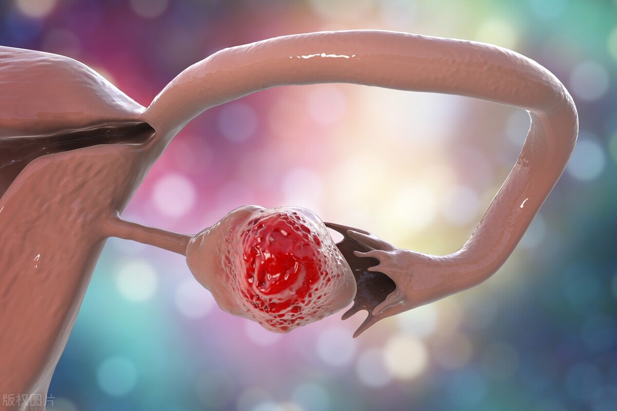 卵巢癌母女,母女两人癌症晚期