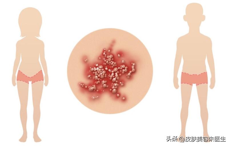 怎么区分尖锐性湿疣和生殖器疱疹,分辨尖锐性湿疣