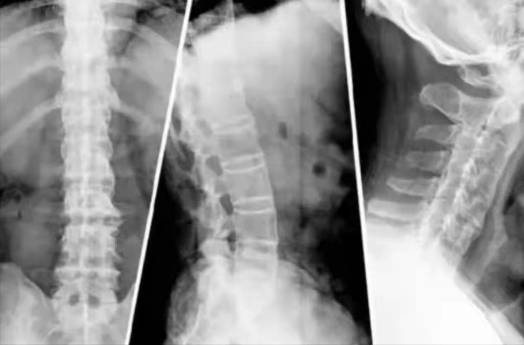 脊柱炎被称为不死的癌症,强直性脊柱炎被称为不死的癌症