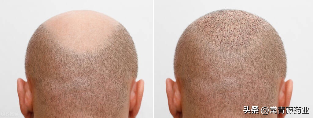 植发拆东墙补西墙感觉不舒服,植发是不是拆东墙补西墙