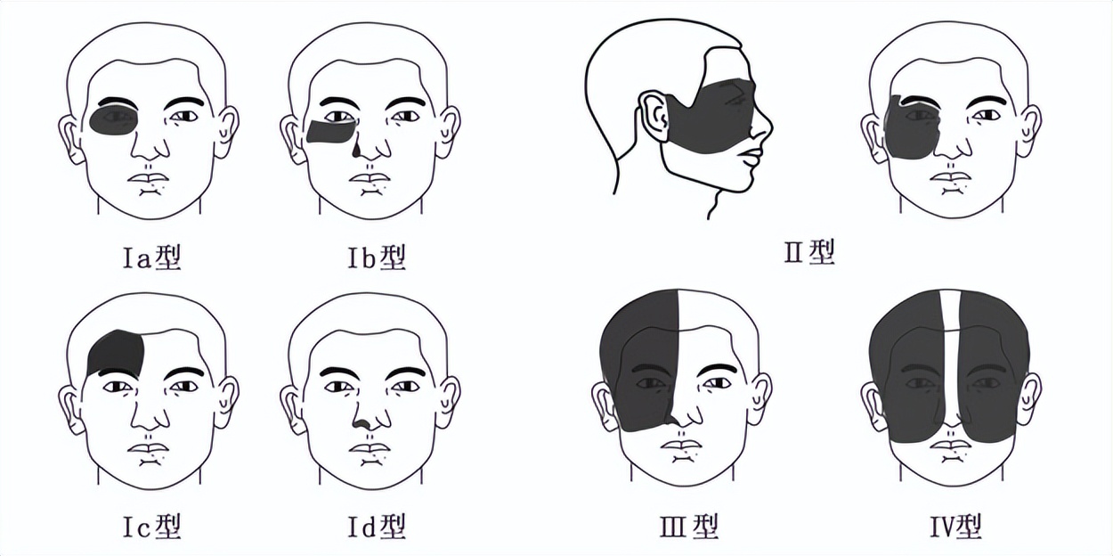 激光打青胎记一般需要几次,1厘米的黑色胎记做激光去除