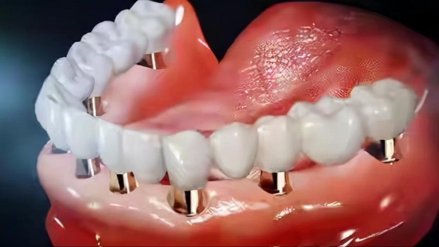 脊柱有钉能做磁共振吗,脊柱手术后有钢丝能照核磁共振吗