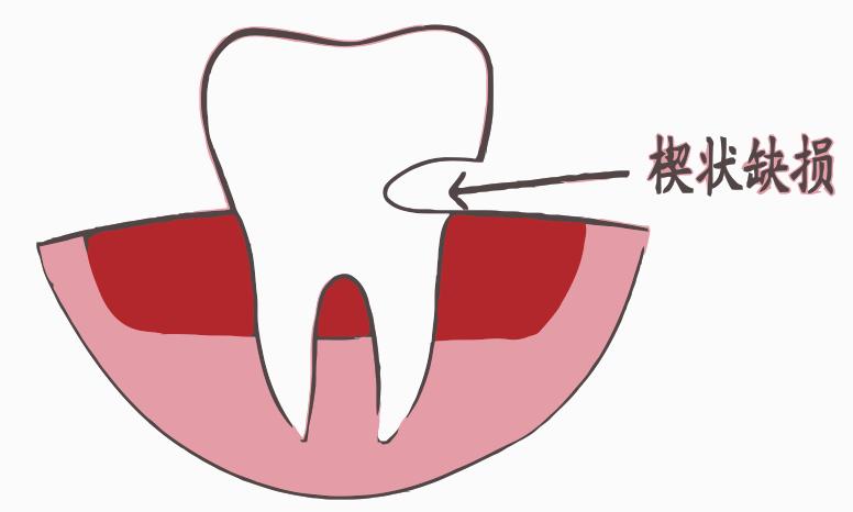楔状缺损轻重症状,牙齿颈部楔状缺损怎么治