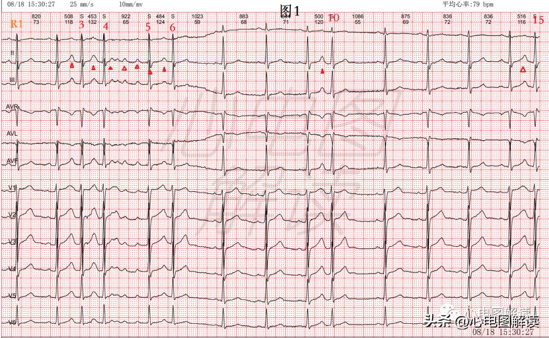 房早室早区别,房早室早房颤