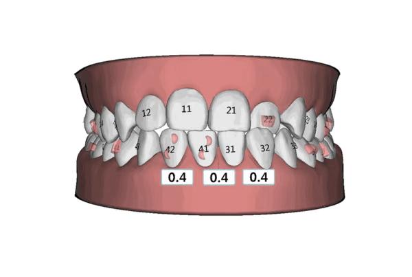 牙齿矫正咬合不对位正常吗,矫正牙齿后面咬合不好怎么办