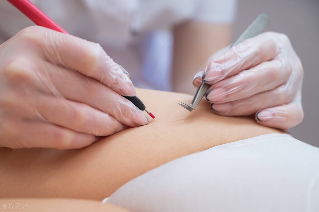 胳膊下的毛能剔除吗,腋窝的毛可以剔除吗