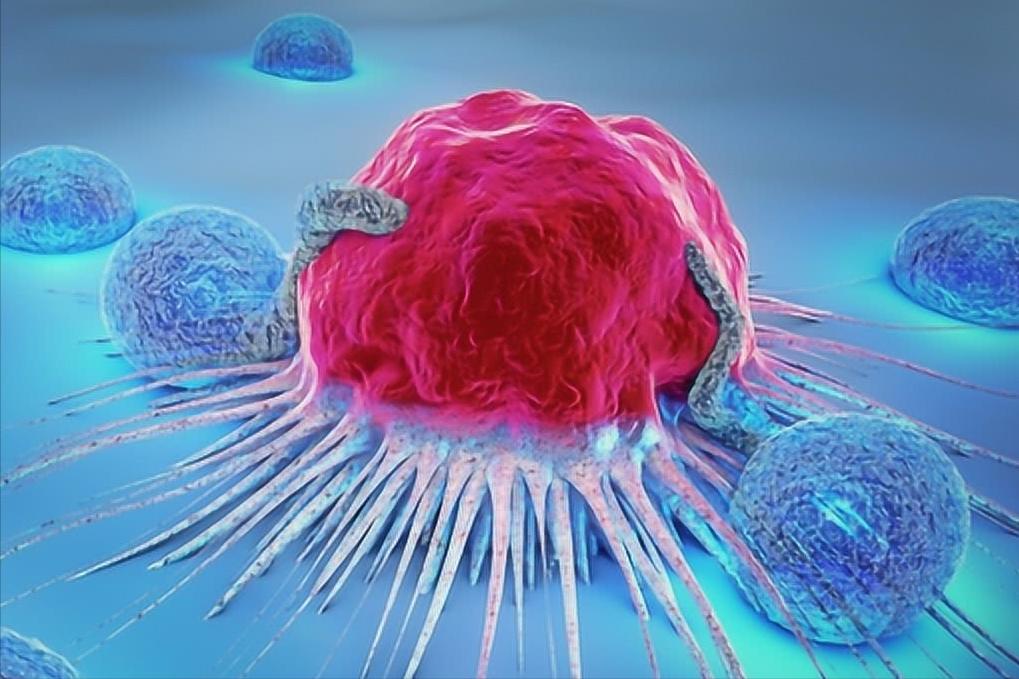 癌症的发病原因及其如何预防,癌症都是先由炎症引起的吗