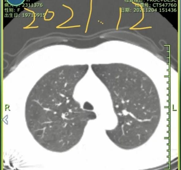 九个月内出现6mm磨玻璃结节,6mm的磨玻璃结节微浸润