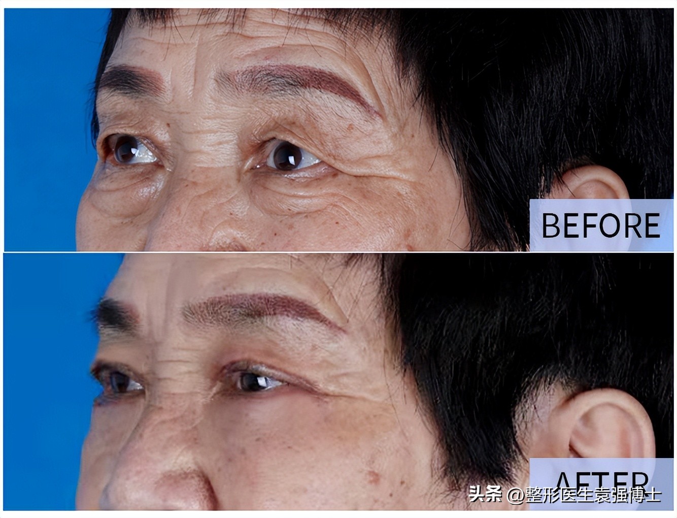 上眼皮耷拉、三角眼、眼皮松，医生说这两种方法很实用