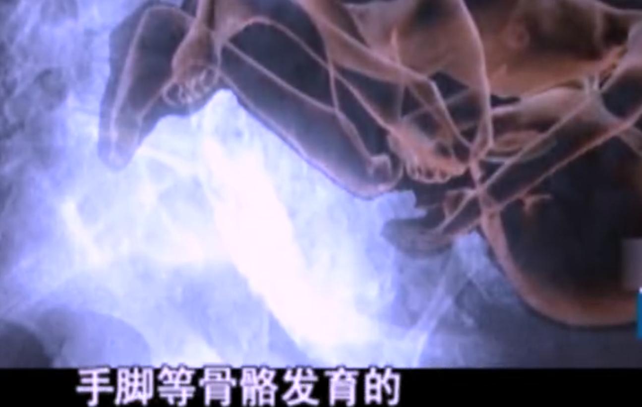 2007年四川90岁老妇，腹中怀子60年未生，后检查发现胎儿没有腐烂