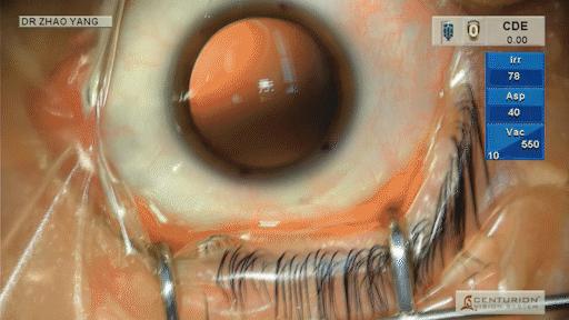 icl植入术技术问题,icd植入适应症指南