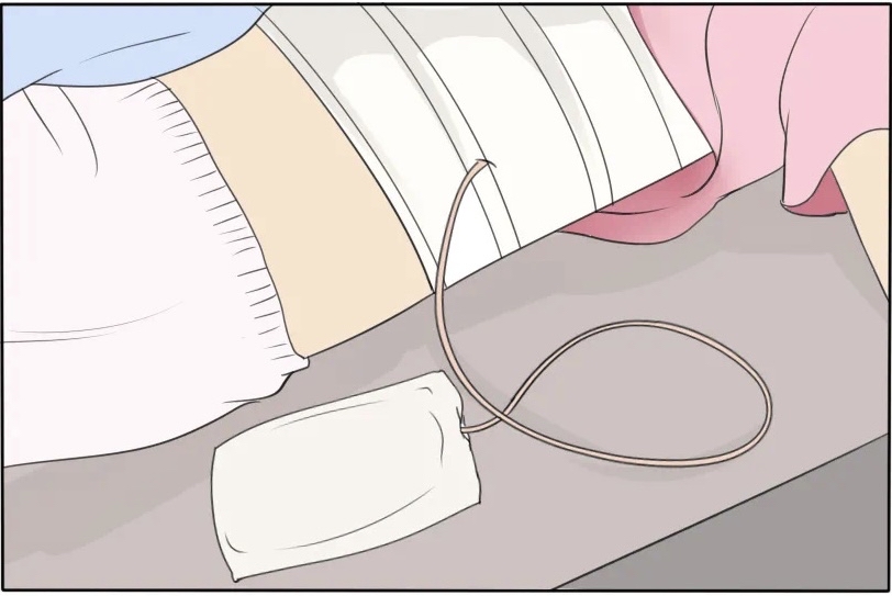 乳腺癌术后胳膊一直疼痛怎么回事,乳腺癌根治术化疗后胳膊上有根筋