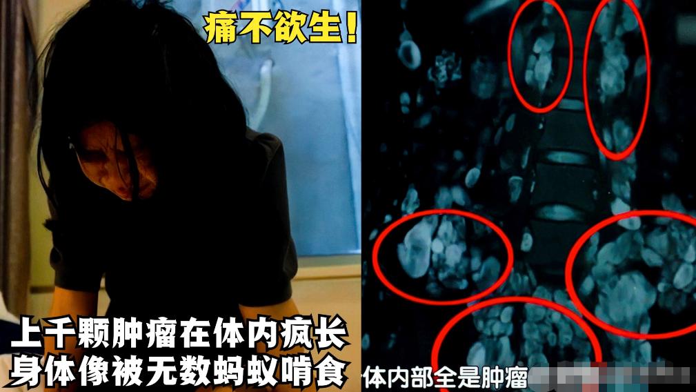女孩体内4000多肿瘤,女孩体内上千肿瘤结果怎么样了