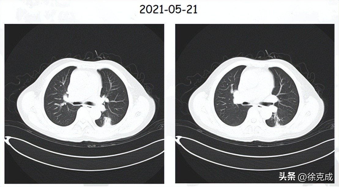 肺癌电场疗法,肺癌吸入疗法