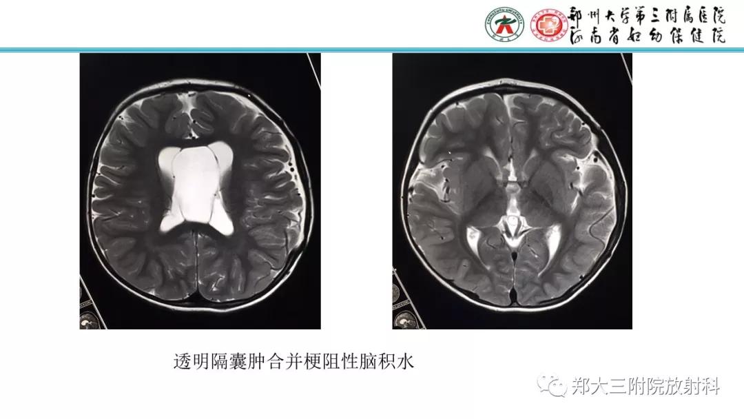 透明隔腔主要是判断什么,透明隔腔宽约10mm什么意思