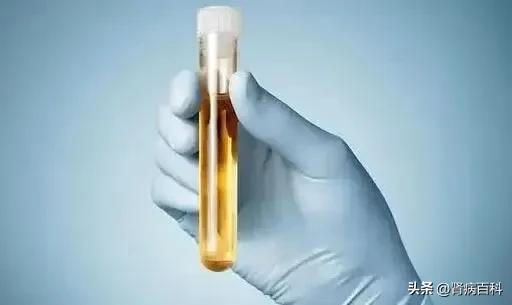 尿蛋白阳性应该多喝水嘛,尿蛋白定量和24小时尿蛋白区别