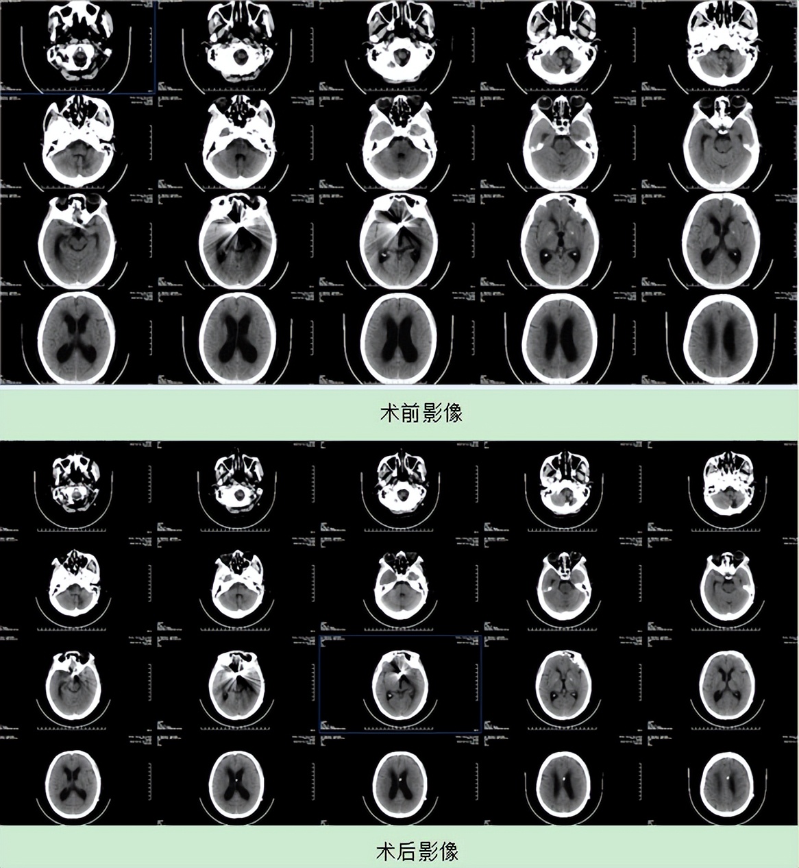 山东患者慕名跨省求医，华安脑科妙手施术