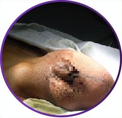 膈疝和疝气是不是一种病,疝气在小肚子上是什么疝