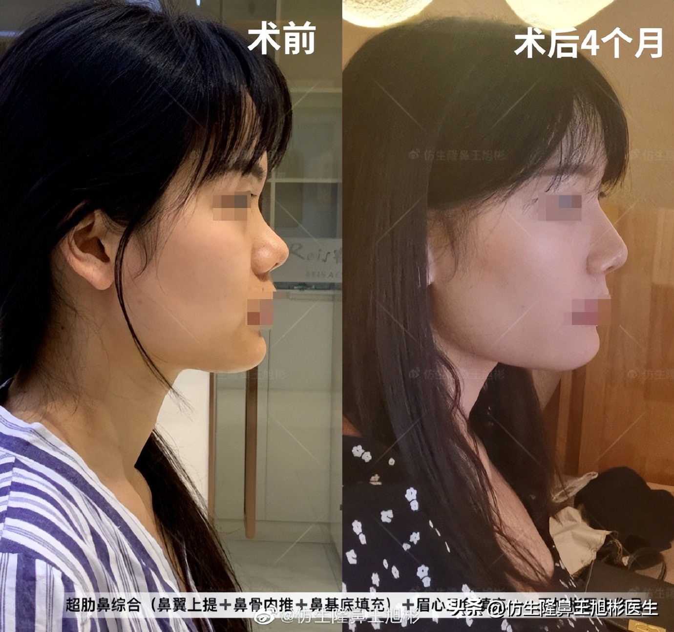 鼻基底填充会移位到鼻孔吗,鼻基底填充假体会拉长人中吗