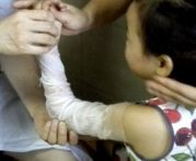 肱骨骨折取钢板怎样恢复,肱骨近端骨折切开复位内固定术