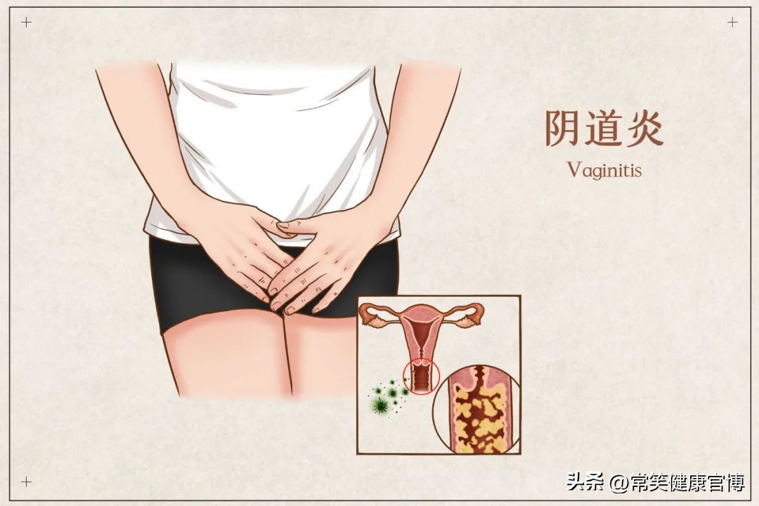 念珠菌性阴道炎症状是hpv问题吗,念珠菌性阴道炎的症状怎么治疗