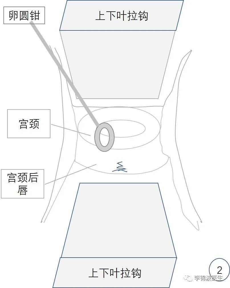 宫颈环扎术的详细步骤,宫颈环扎线拆除多少钱