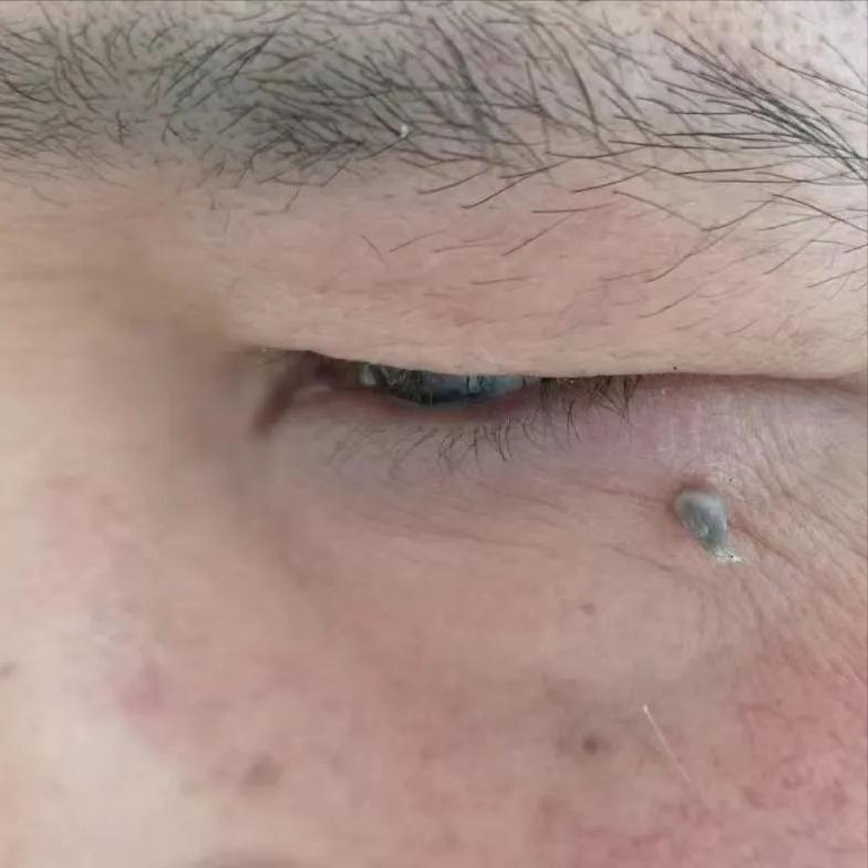 脸上长硬硬的小鼓包,脸上长小米粒疙瘩怎么办